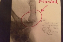 Dislocated Thumb